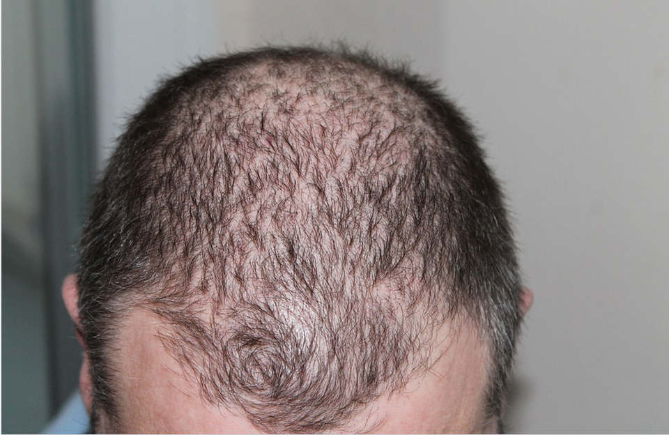 hair loss on a man's head